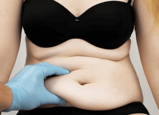 Abdominoplastie 1