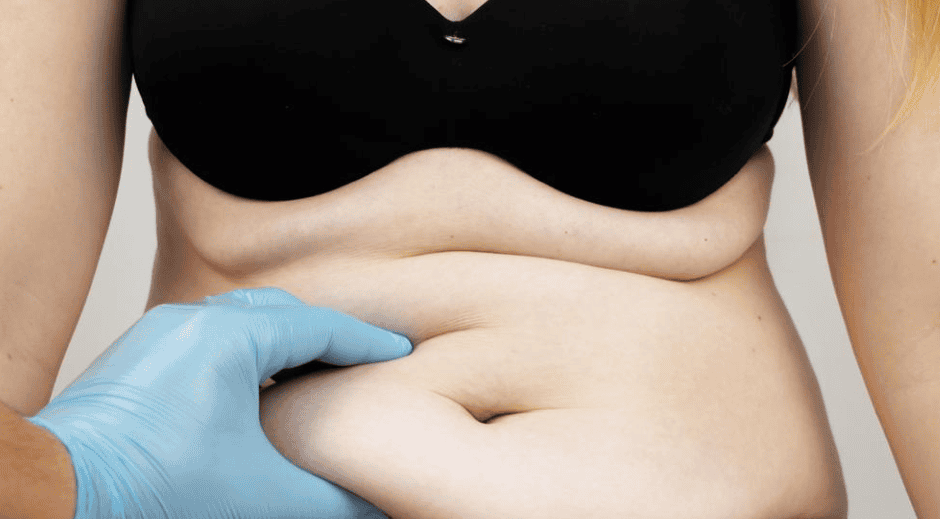 Abdominoplastie 1