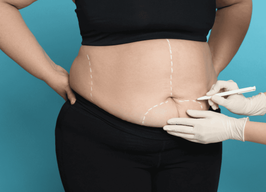 Abdominoplastie 2