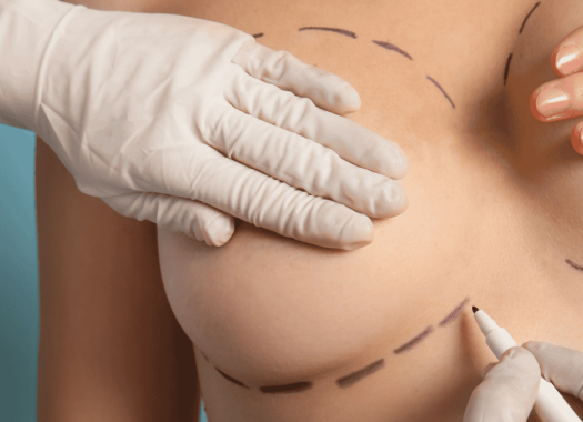 Augmentation mammaire1