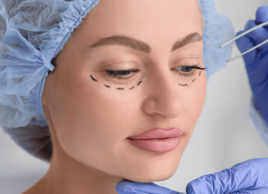 Blépharoplastie2