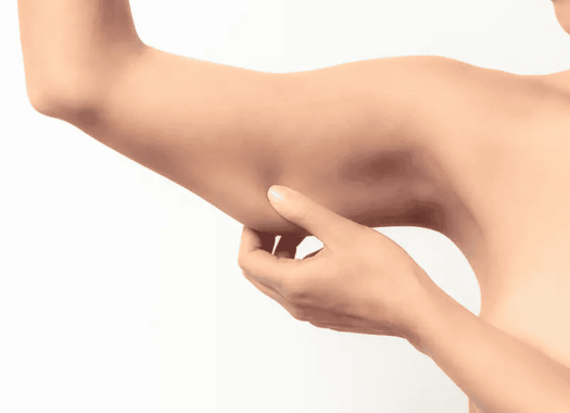 Brachioplastie 1