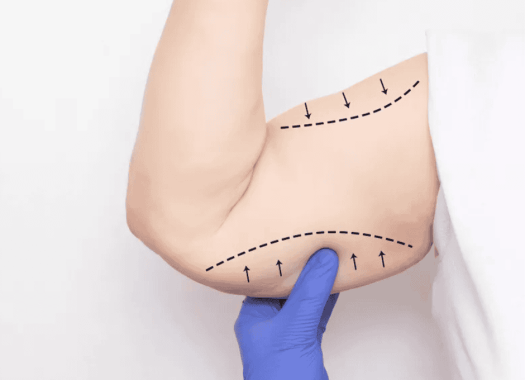 Brachioplastie 2