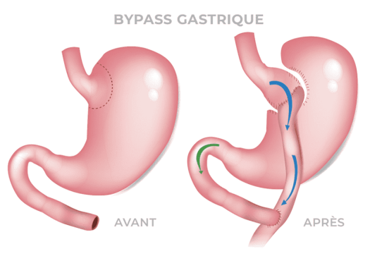 Bypass Gastrique 2