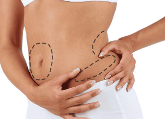 Liposuccion HD 1
