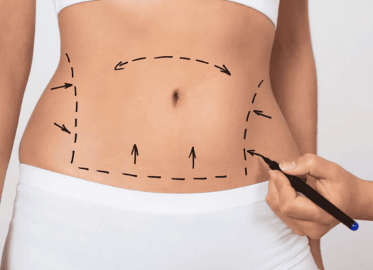Liposuccion HD 2