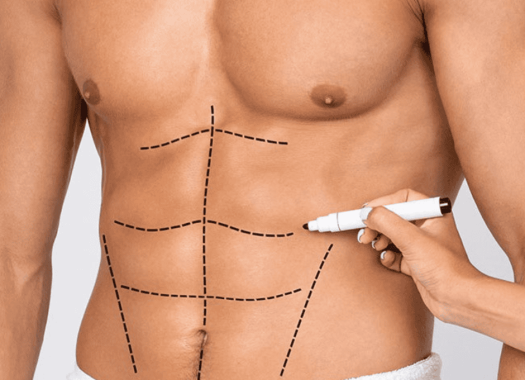 Liposuccion1