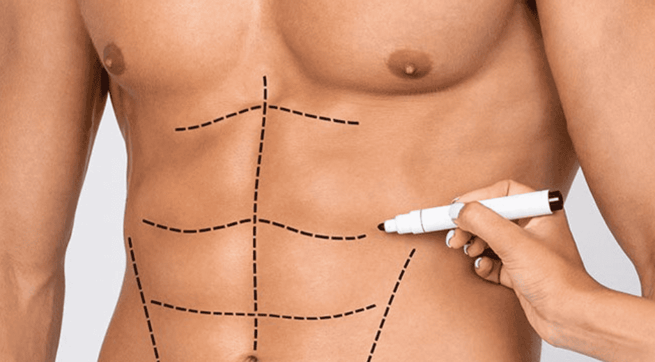 Liposuccion1