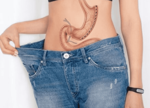 Sleeve Gastrectomie 1