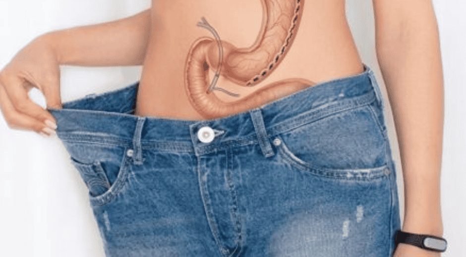 Sleeve Gastrectomie 1