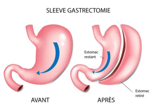 Sleeve Gastrectomie 2